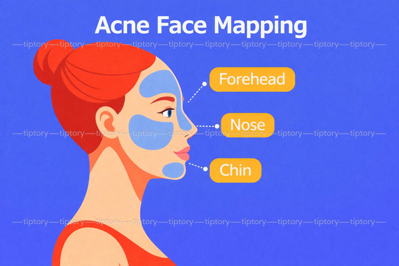 Nguyên nhân gây mụn ở từng vị trí trên mặt: 8 vị trí mụn đoán bệnh